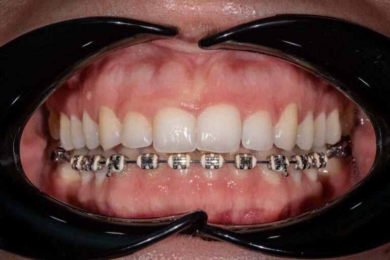 Przypadek kliniczny nr3 – Chirurgiczne wydłużenie koron klinicznych z powodu zaburzonego biernego wyrzynania zębów