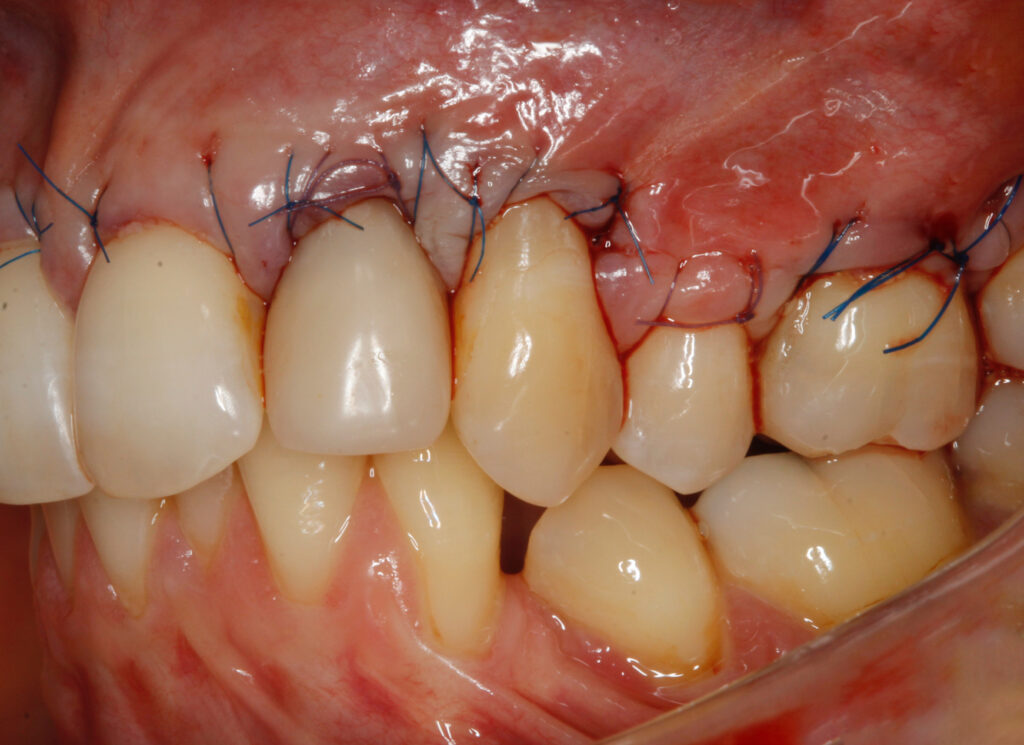 Zęby po zabiegu chirurgiczneym