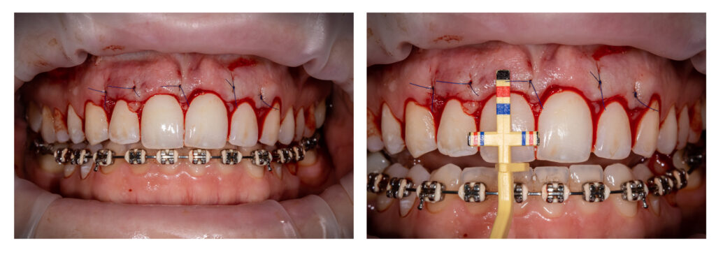 Chirurgia zębów