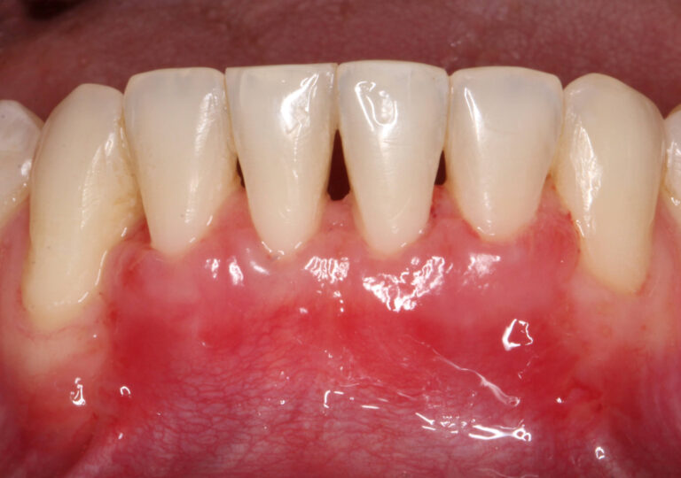 Przypadek kliniczny nr 4 – Pokrycie mnogich recesji dziąseł przy dolnych zębach siecznych